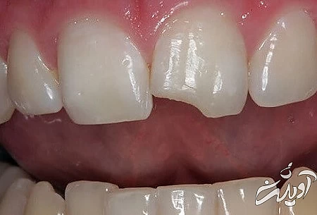 خرد شدن دندان, علت های خرد شدن دندان ها, خرد شدن دندان ها